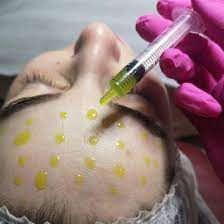 Gloved hand injects yellow serum into a person’s face during a cosmetic treatment
