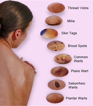 Skin close-up chart showing labeled examples of veins, moles, warts, and other lesions.