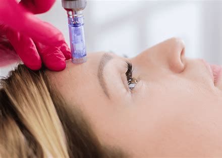 Gloved hand using a microneedling device on a woman's forehead during a facial treatment