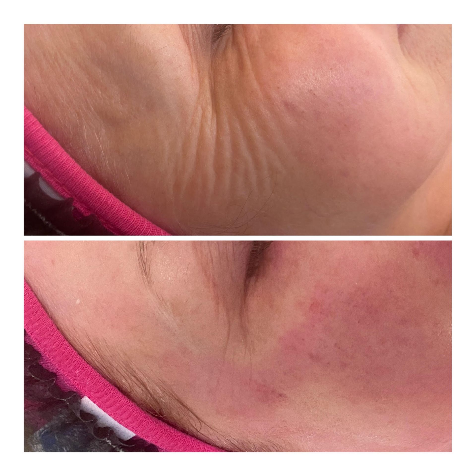 Close-up of skin on cheek and chin with redness and wrinkles
