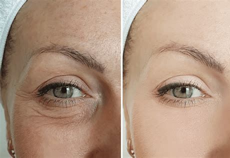 Split close-up of an eye area before and after skin smoothing, showing reduced wrinkles and under-eye shadows