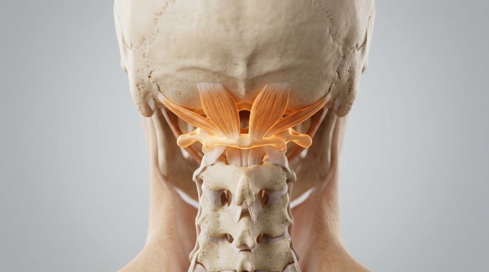 Suboccipital neck muscles and the atlas vertebra highlighting the structural source of tension