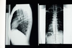 Upper Cervical Chiropractic and Scoliosis