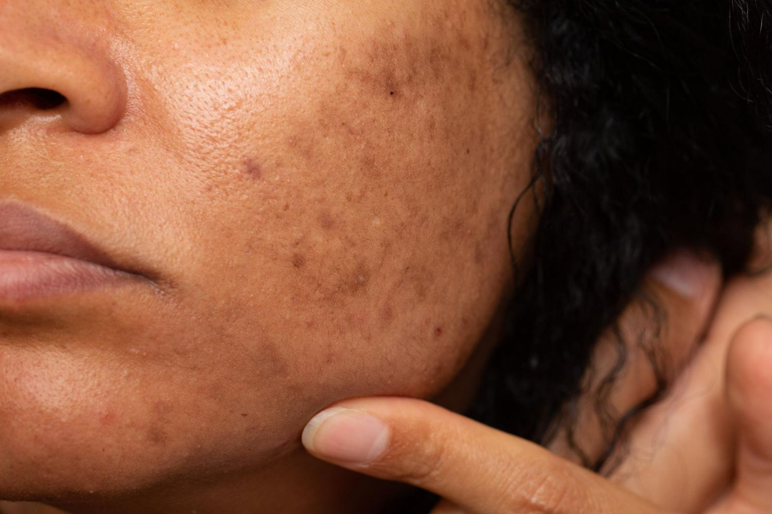 Close-up of a person's face with dark spots on the cheek, jawline, and side of the face; a finger points to the spots.