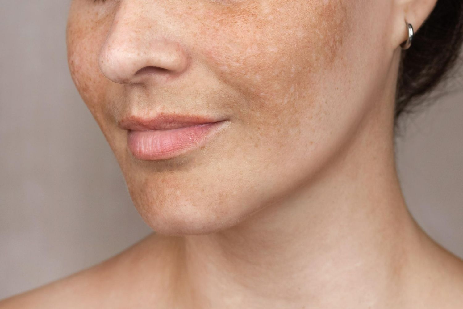 Woman with facial hyperpigmentation, likely melasma, on cheeks and upper lip.