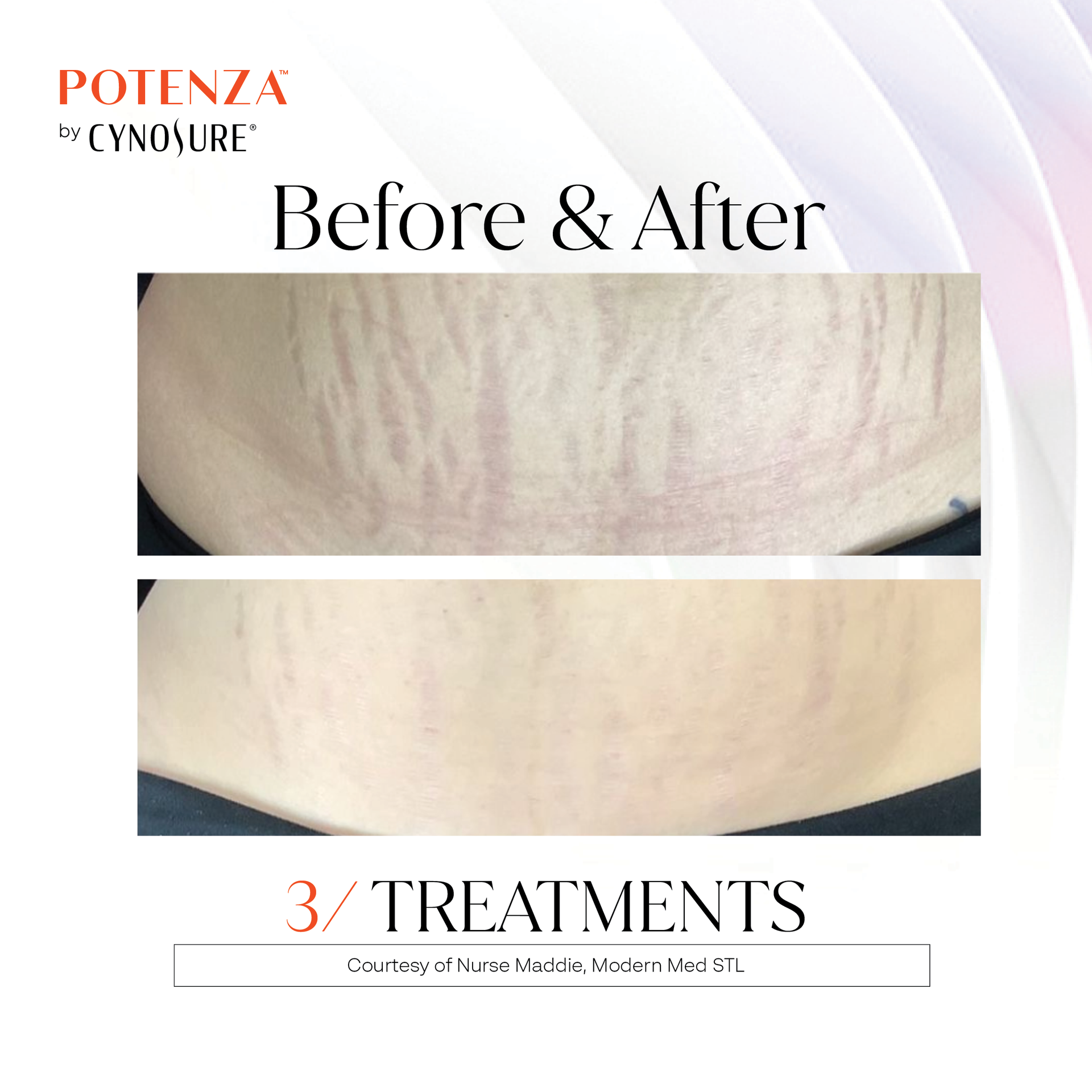 A before and after photo of stretch marks on a woman 's stomach.