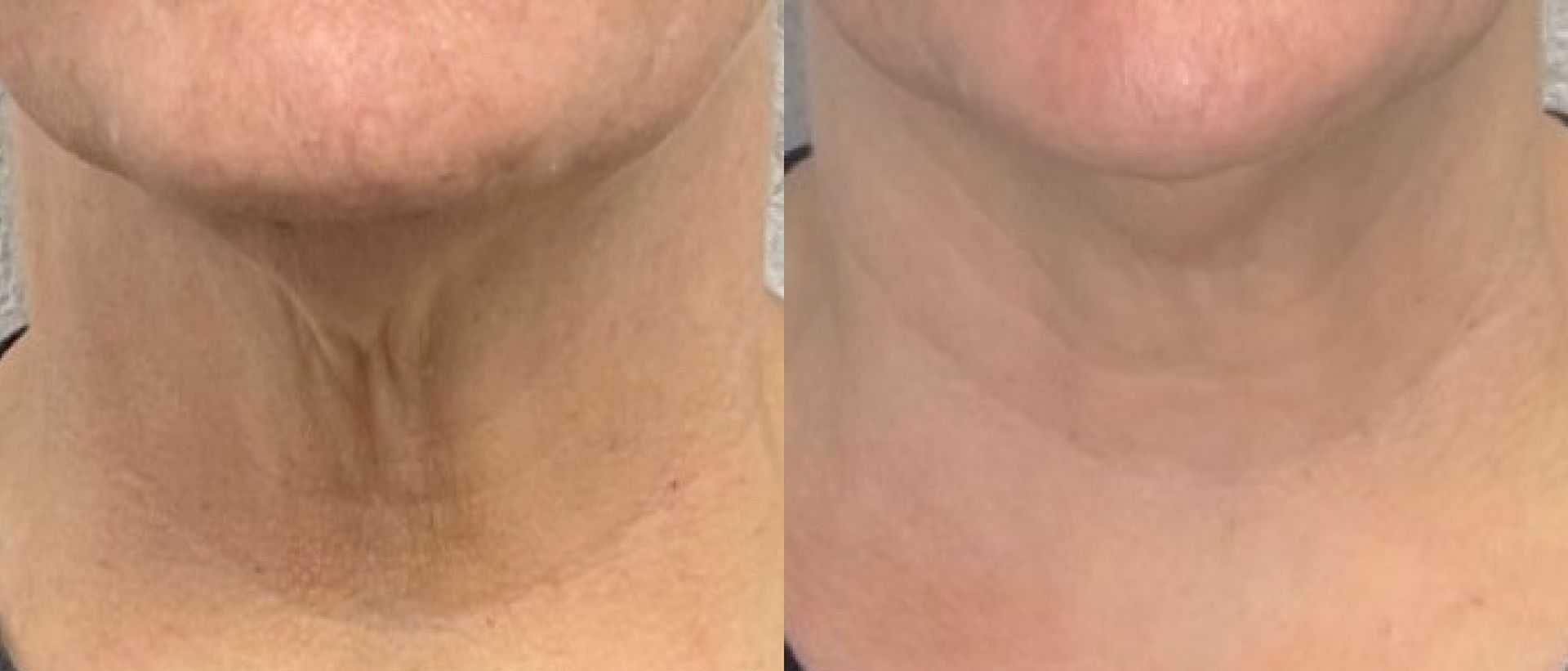 A woman 's neck is shown before and after a treatment.