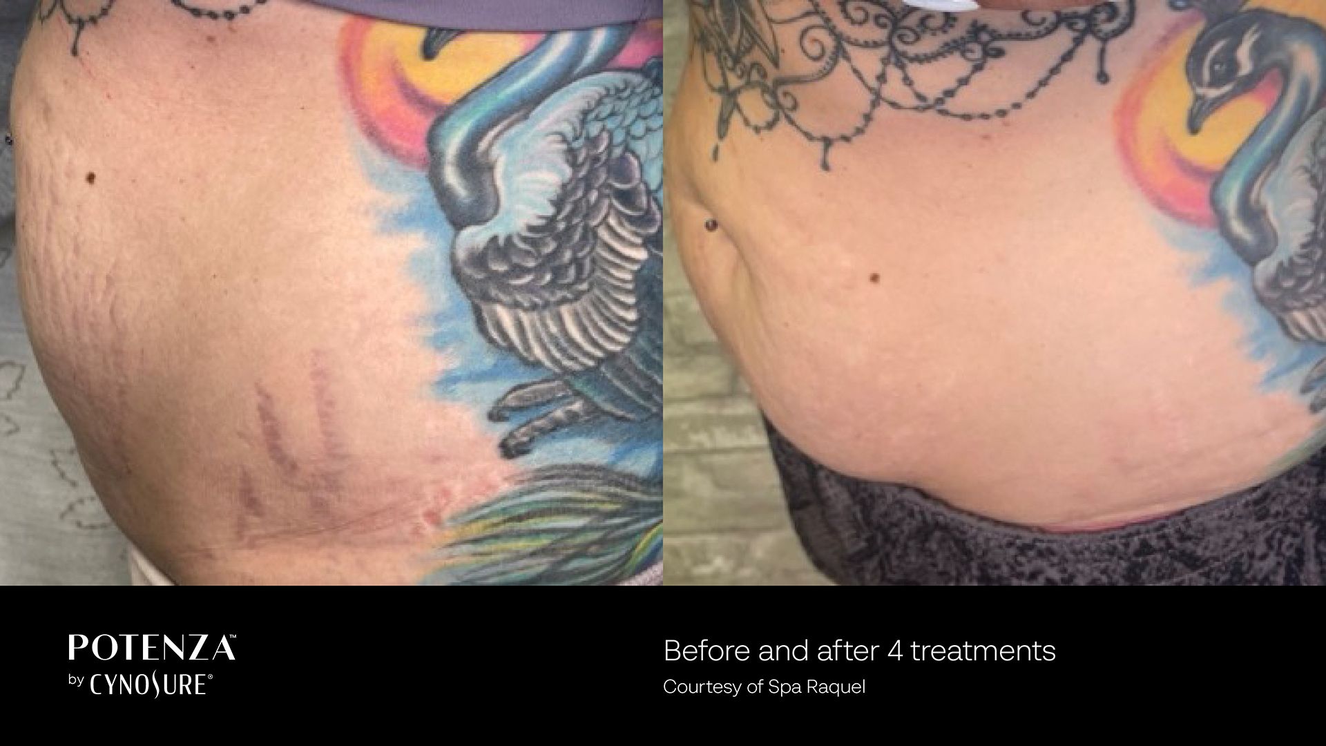 A before and after photo of a woman 's stomach with stretch marks.