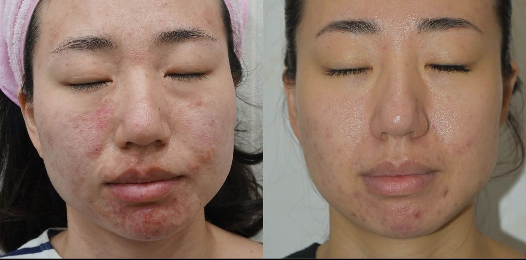 A before and after photo of a woman 's face with acne.