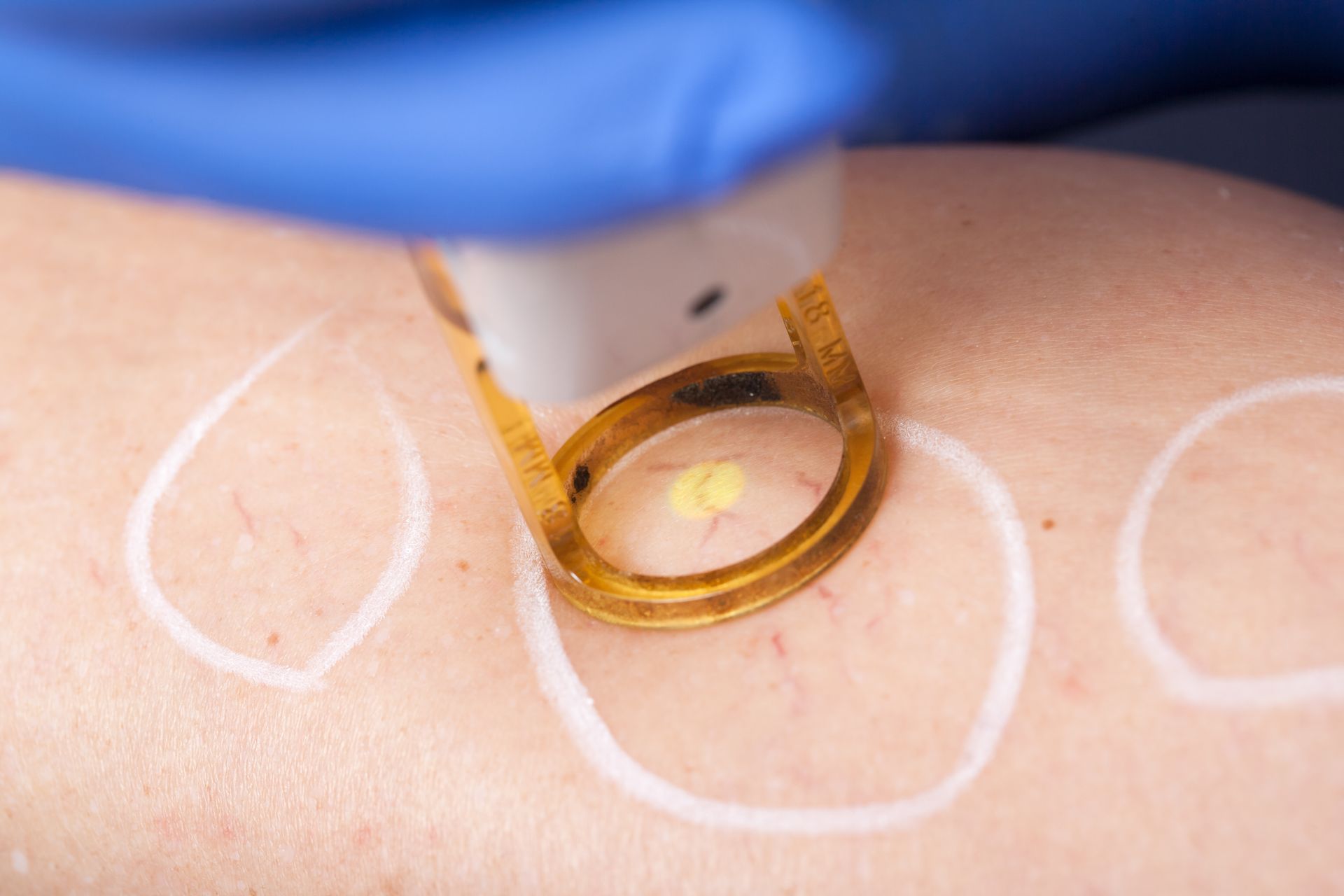 A person is getting a laser treatment on their leg.