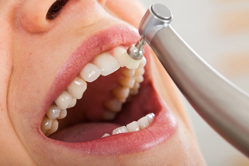 Professional Dental Cleaning — Dental Clinic in Buderim, QLD