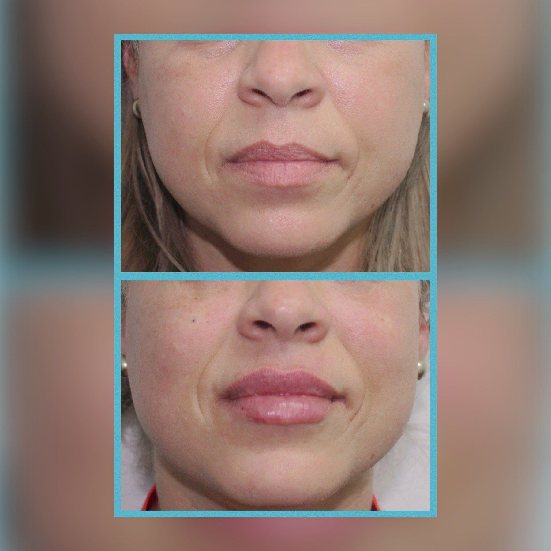 Lip Fillers 1