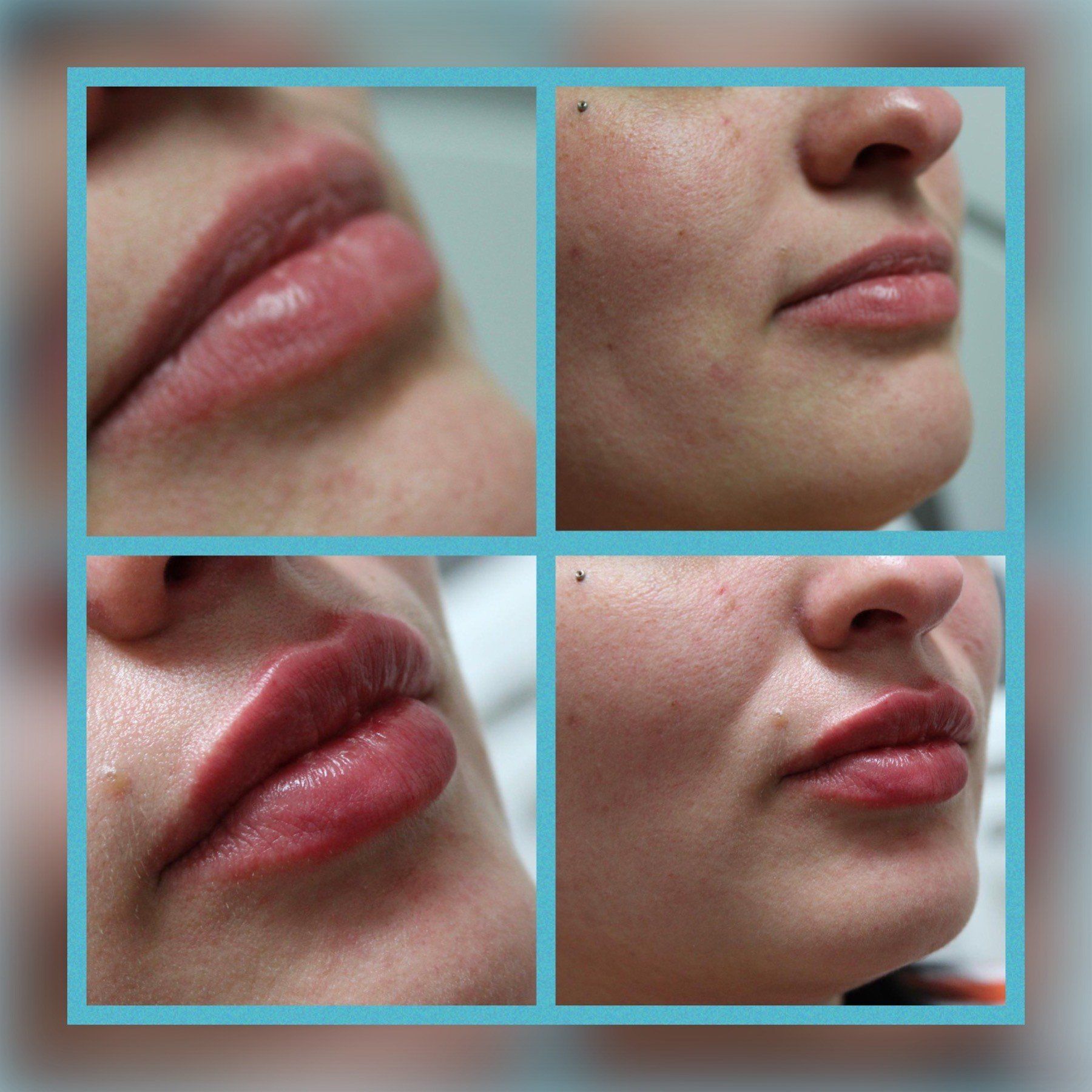 Lip Fillers 2