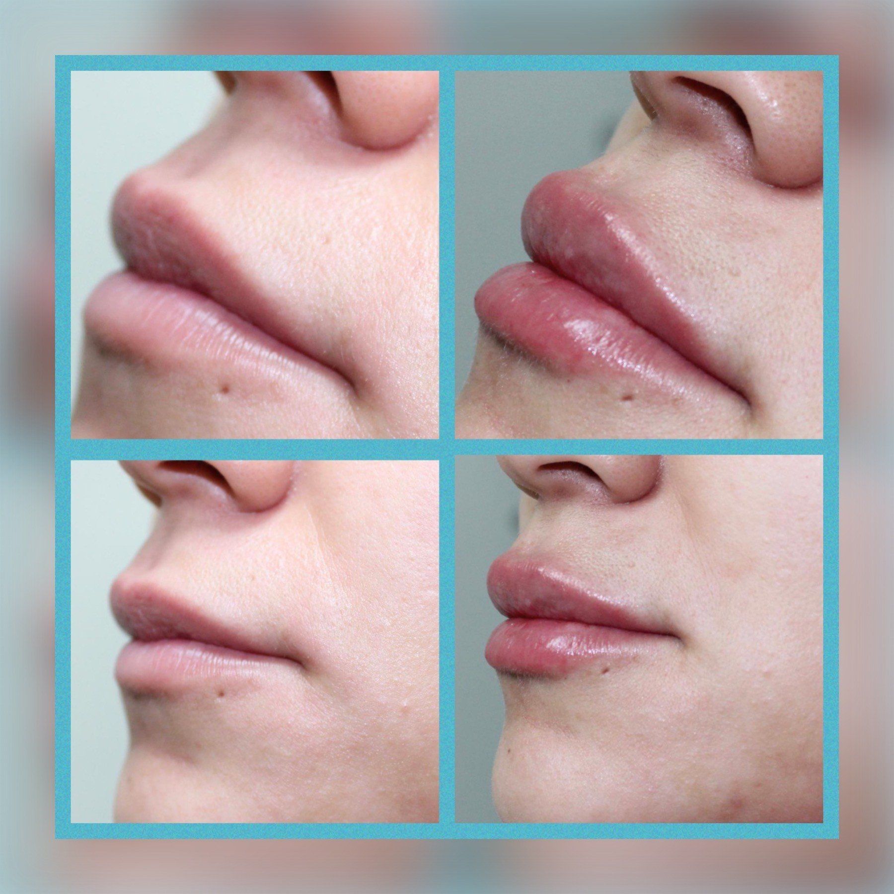 Lip Fillers 3