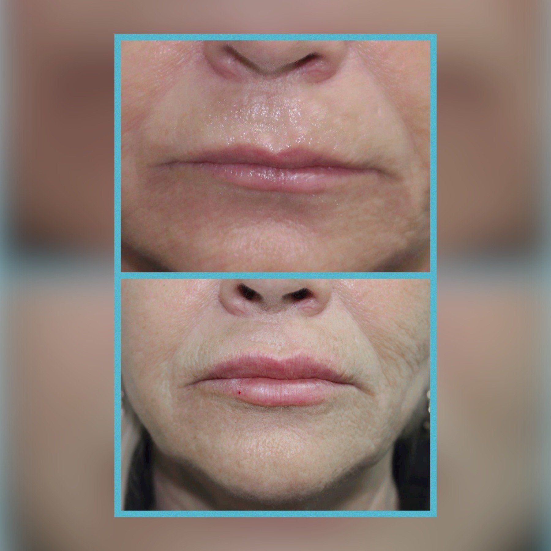 Lip Fillers 4