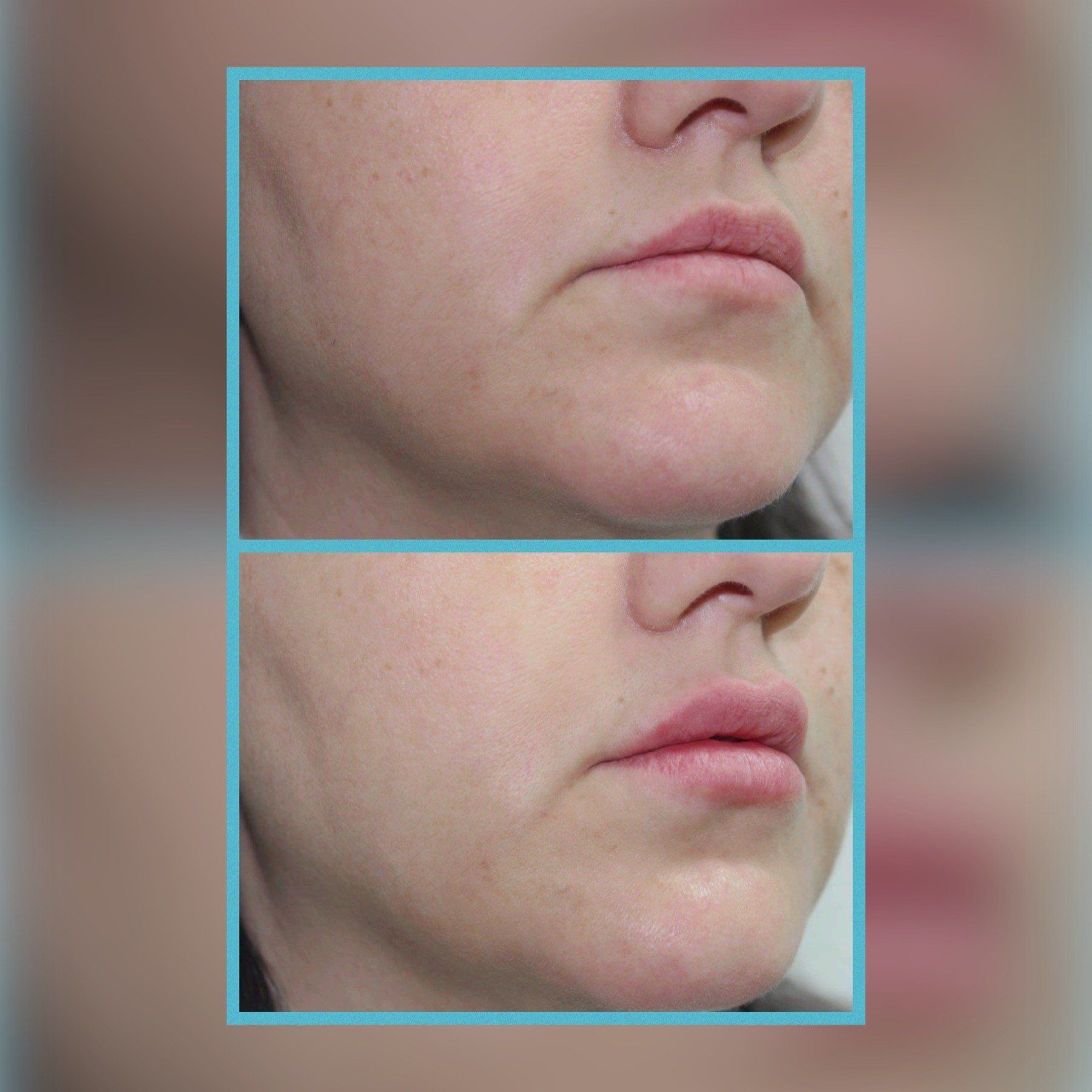 Lip Fillers 5