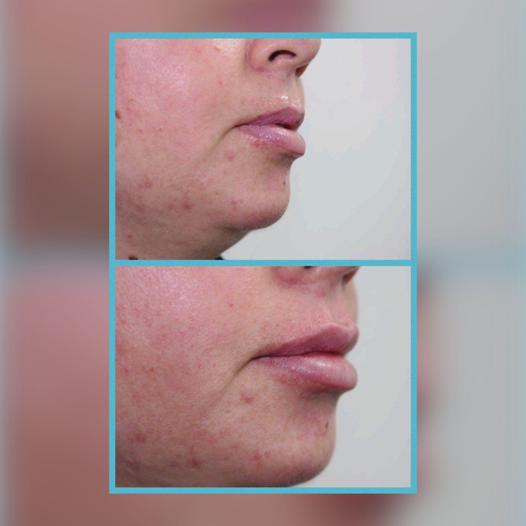 Lip Fillers 6