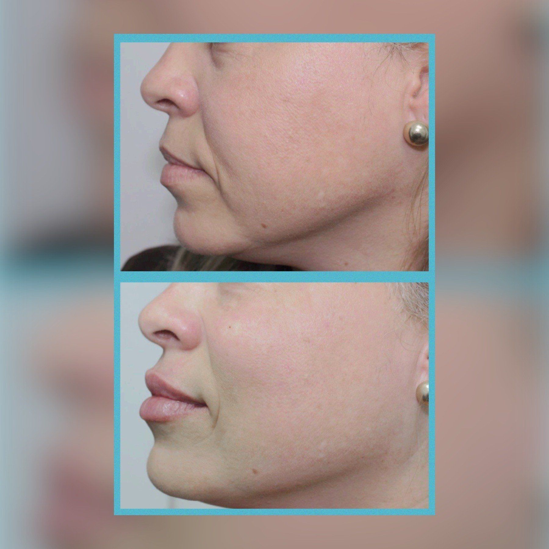 Lip Fillers 7