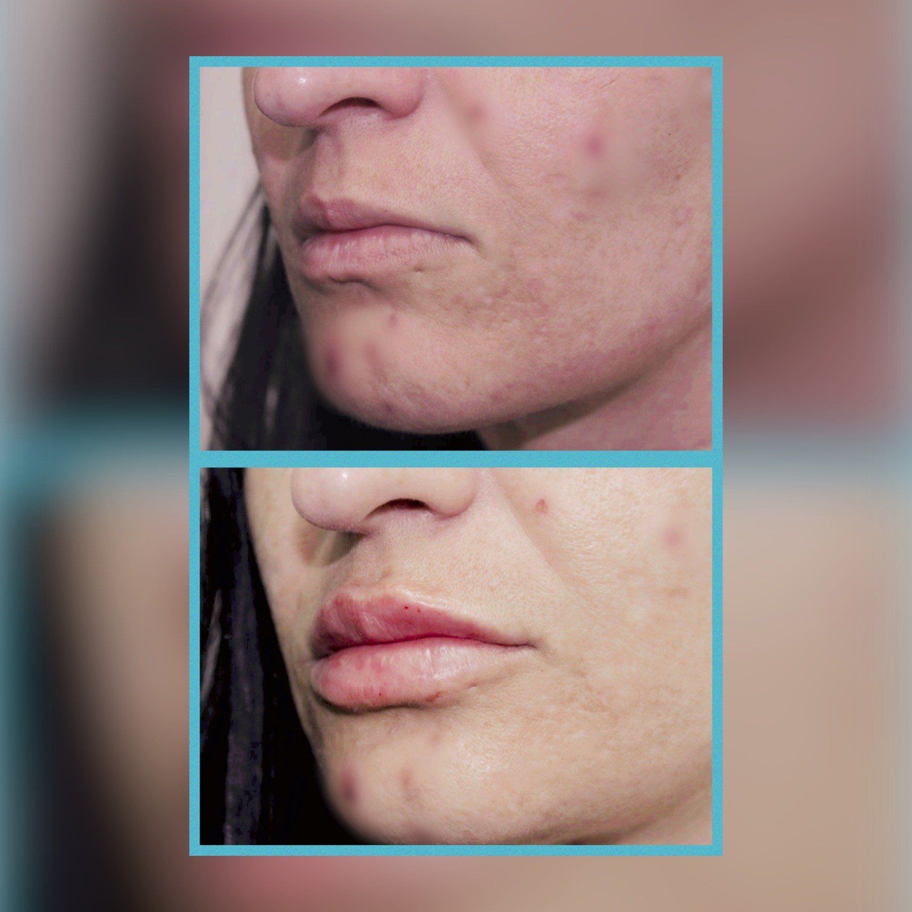 Lip Fillers 8