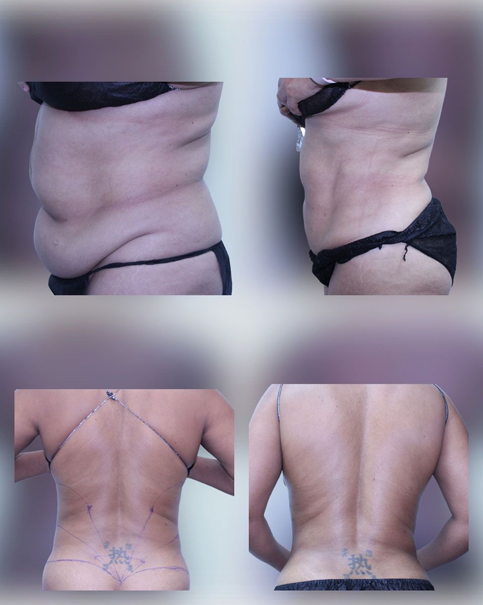 Liposuction 1