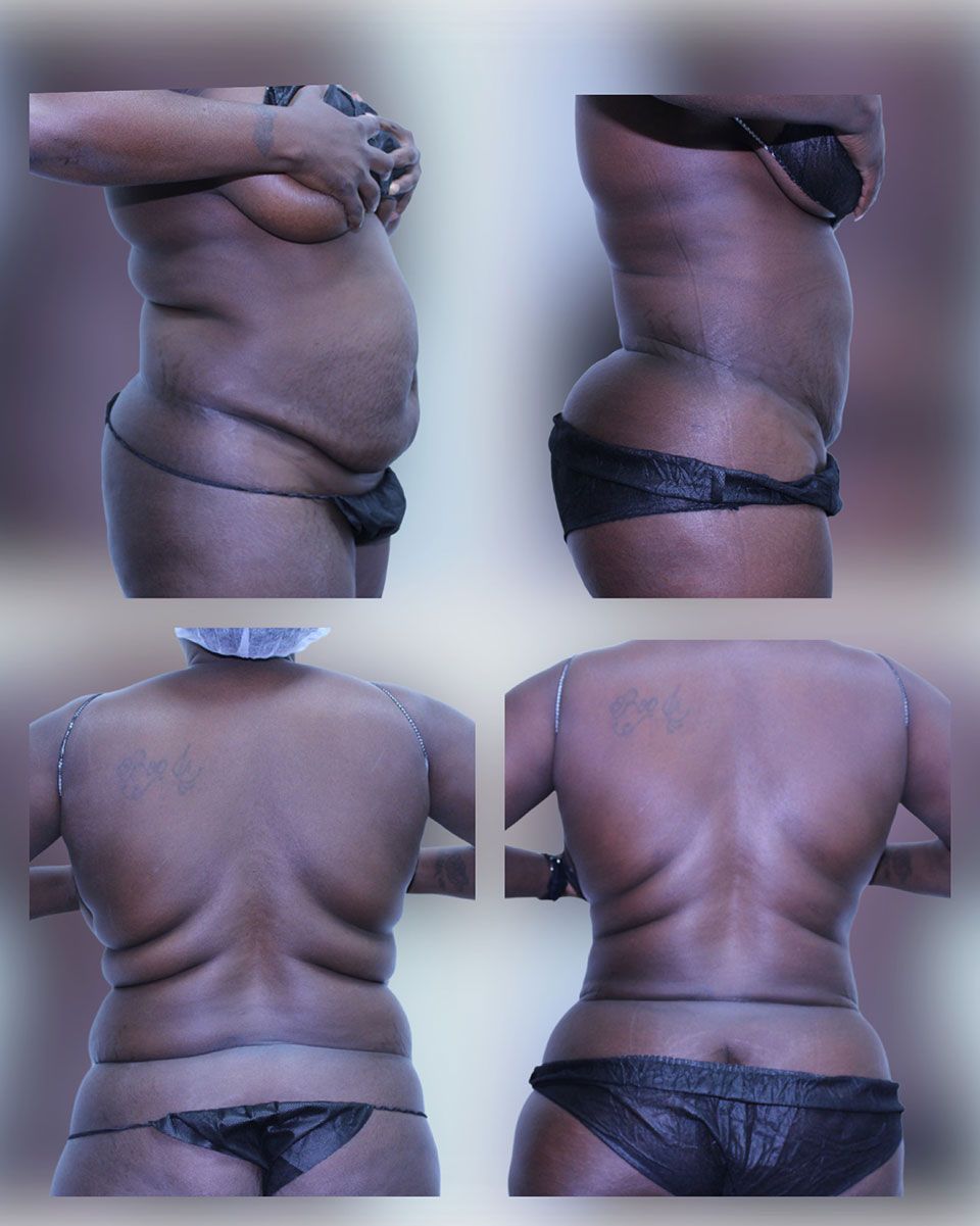 Liposuction 2