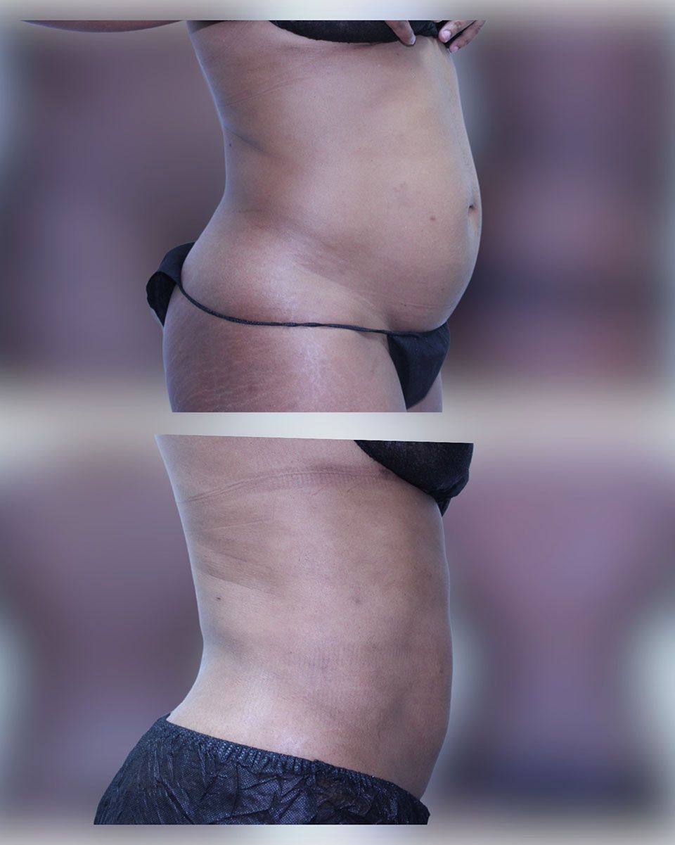 Liposuction 3
