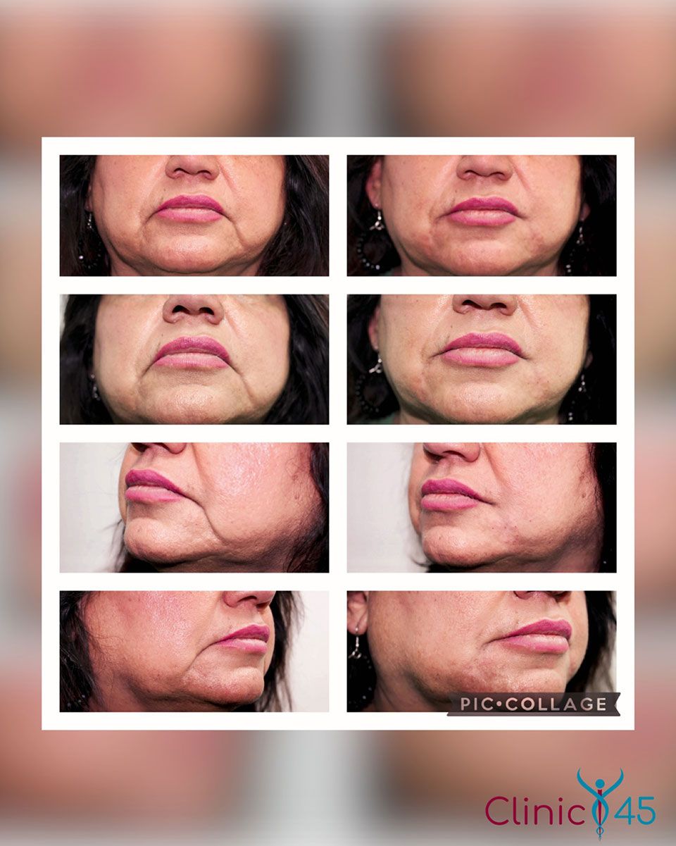 Dermal Fillers 1