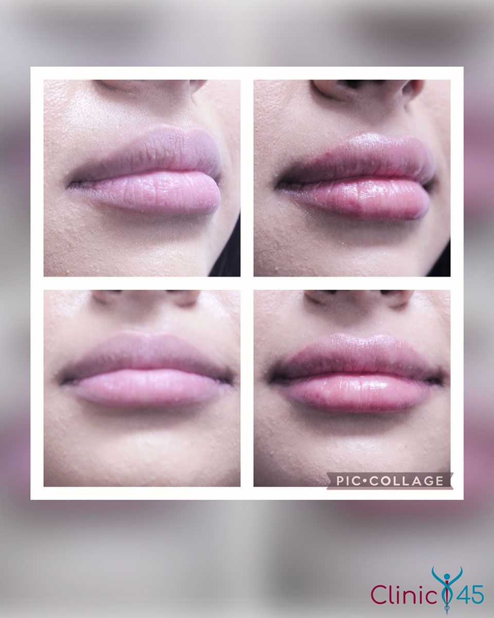Dermal Fillers 2