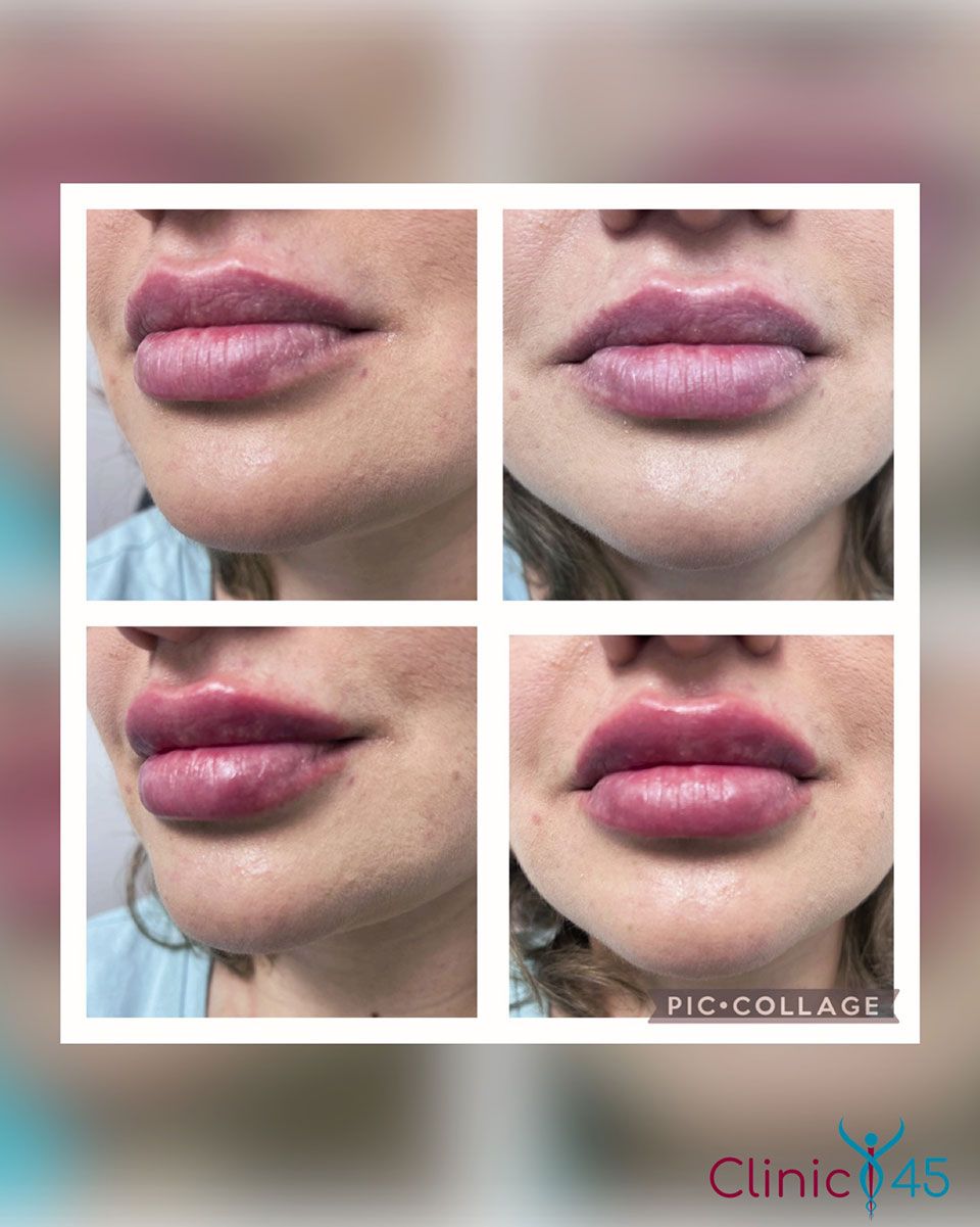 Dermal Fillers 3