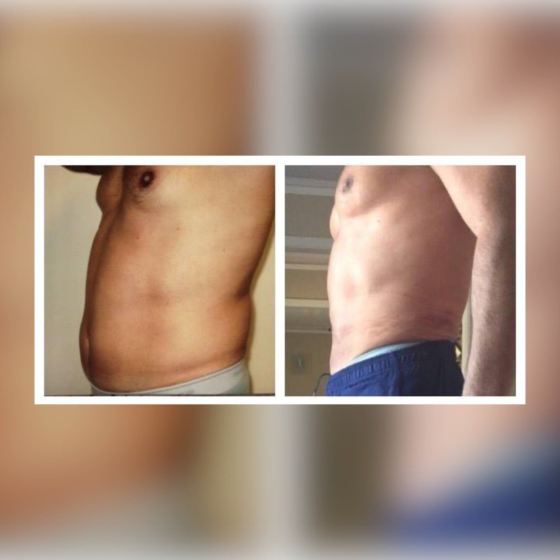 Smartlipo 10