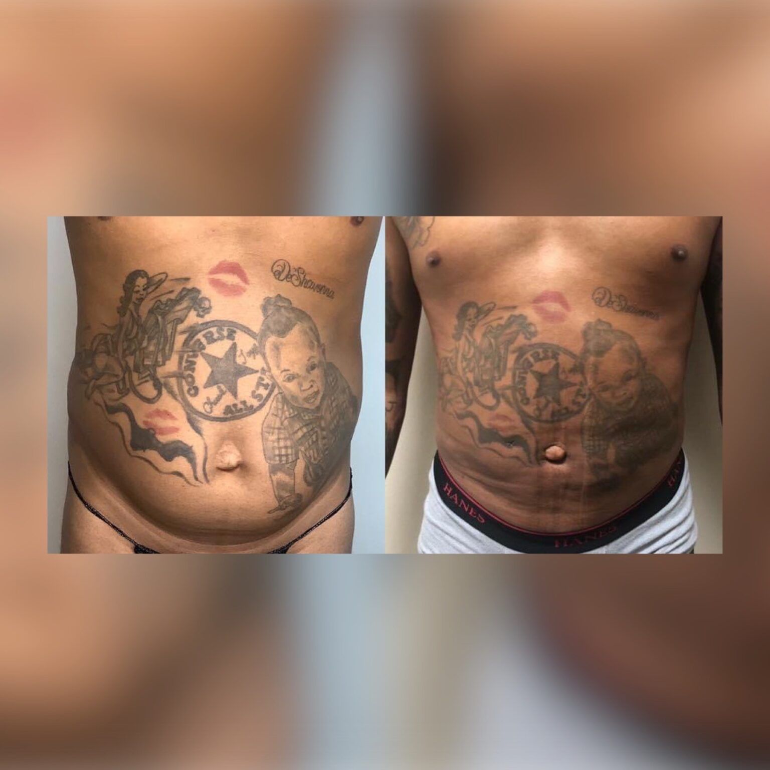 Smartlipo 11