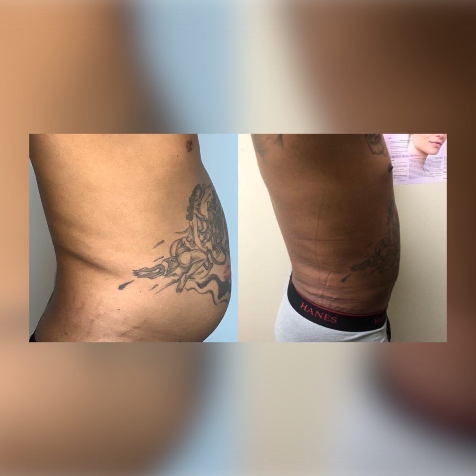 Smartlipo 12