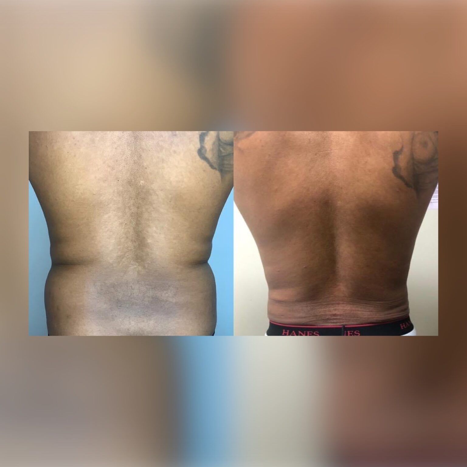 Smartlipo 13