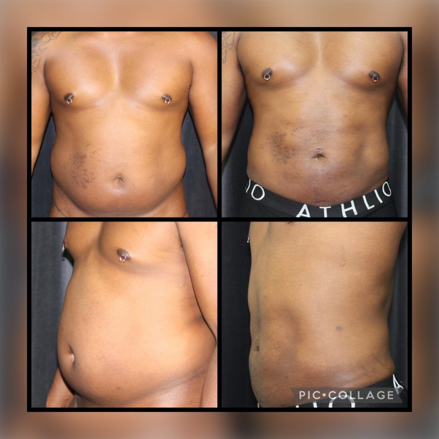 Smartlipo 14