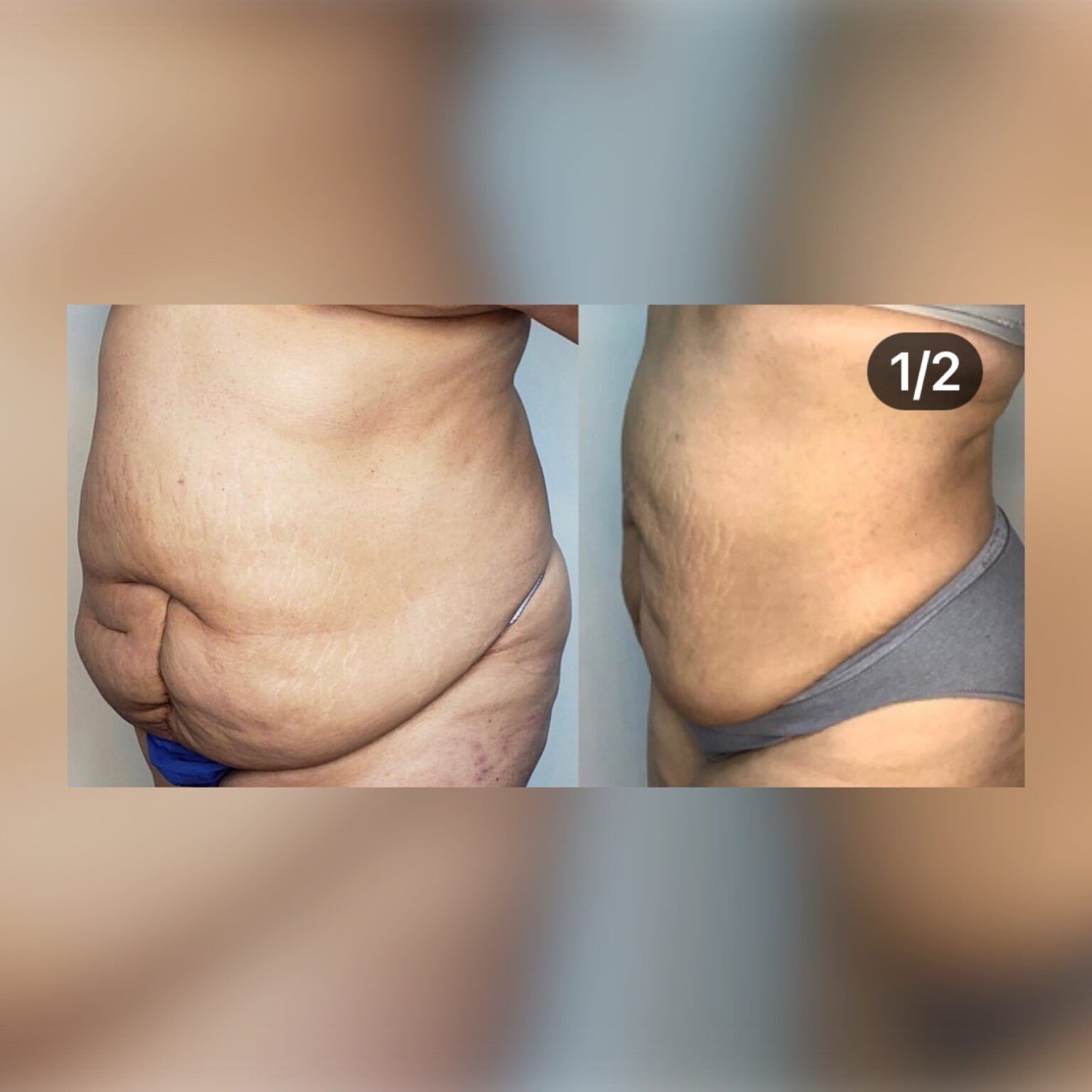 Smartlipo 15