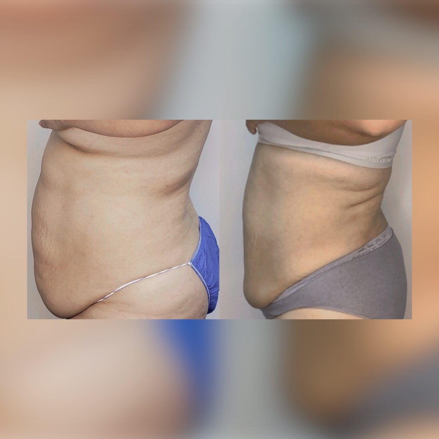 Smartlipo 16