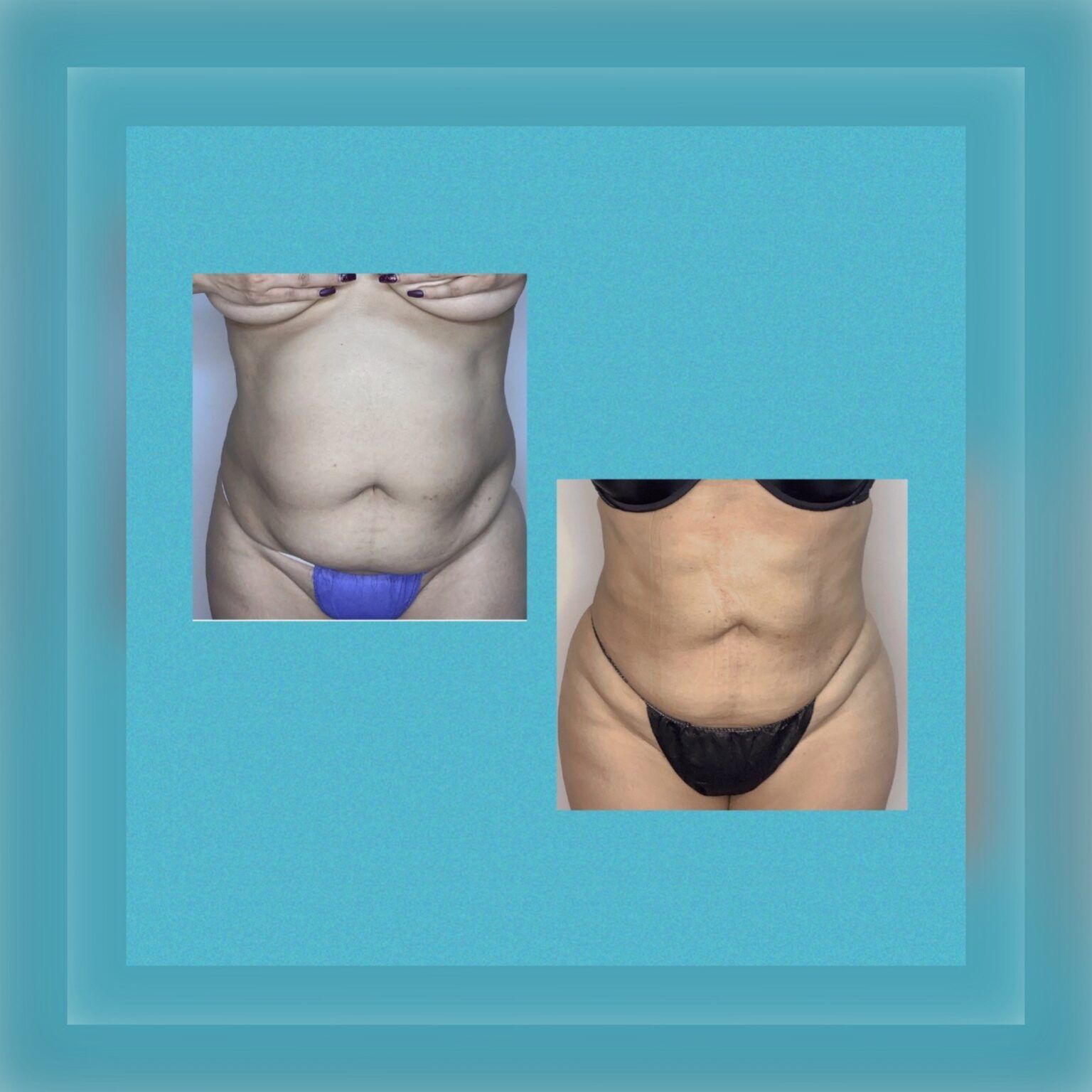 Smartlipo 17