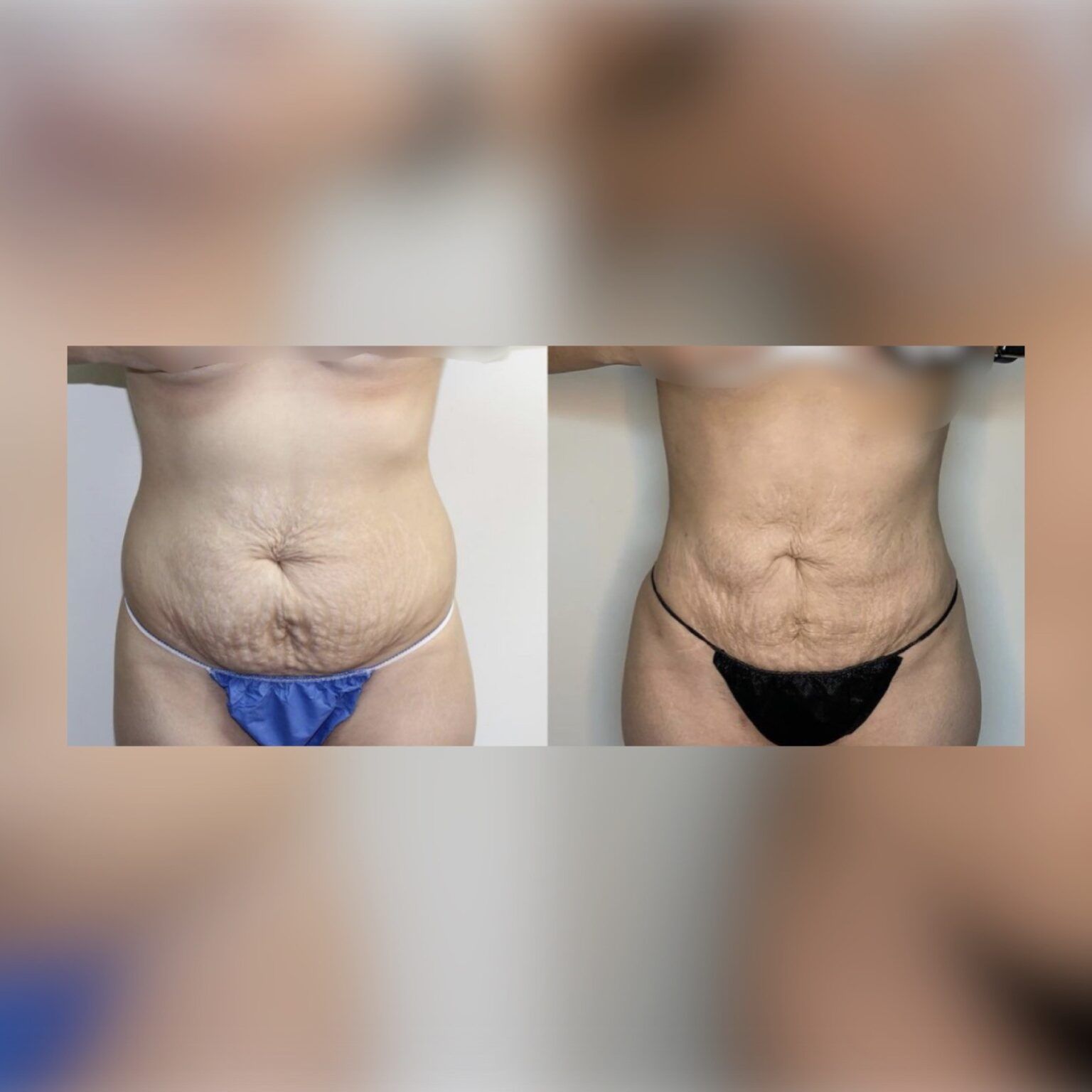 Smartlipo 18