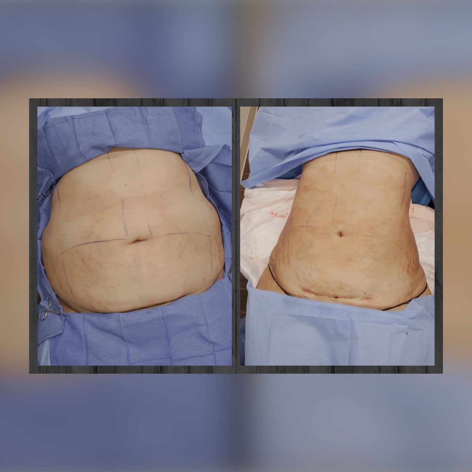 Smartlipo 19