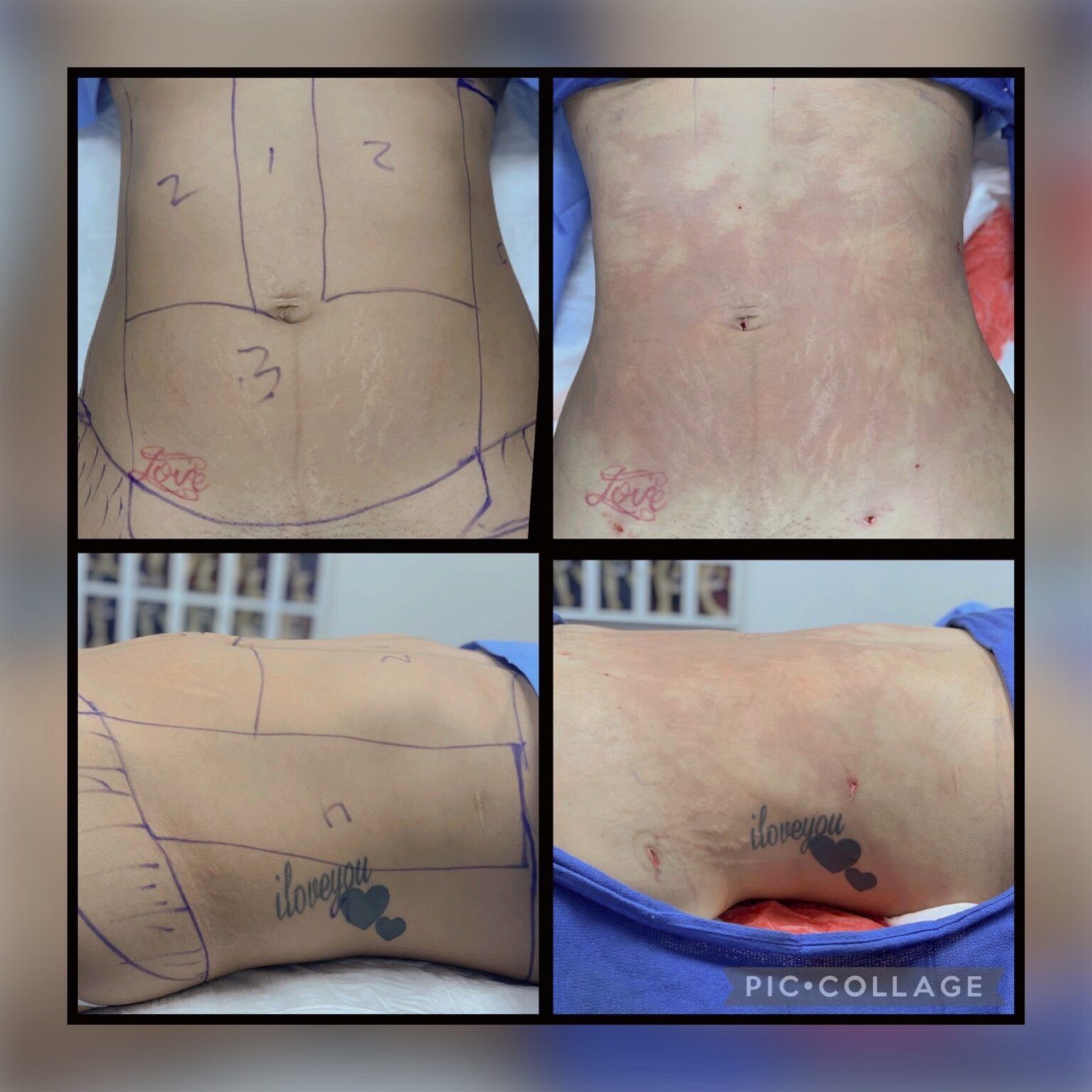 Smartlipo 20