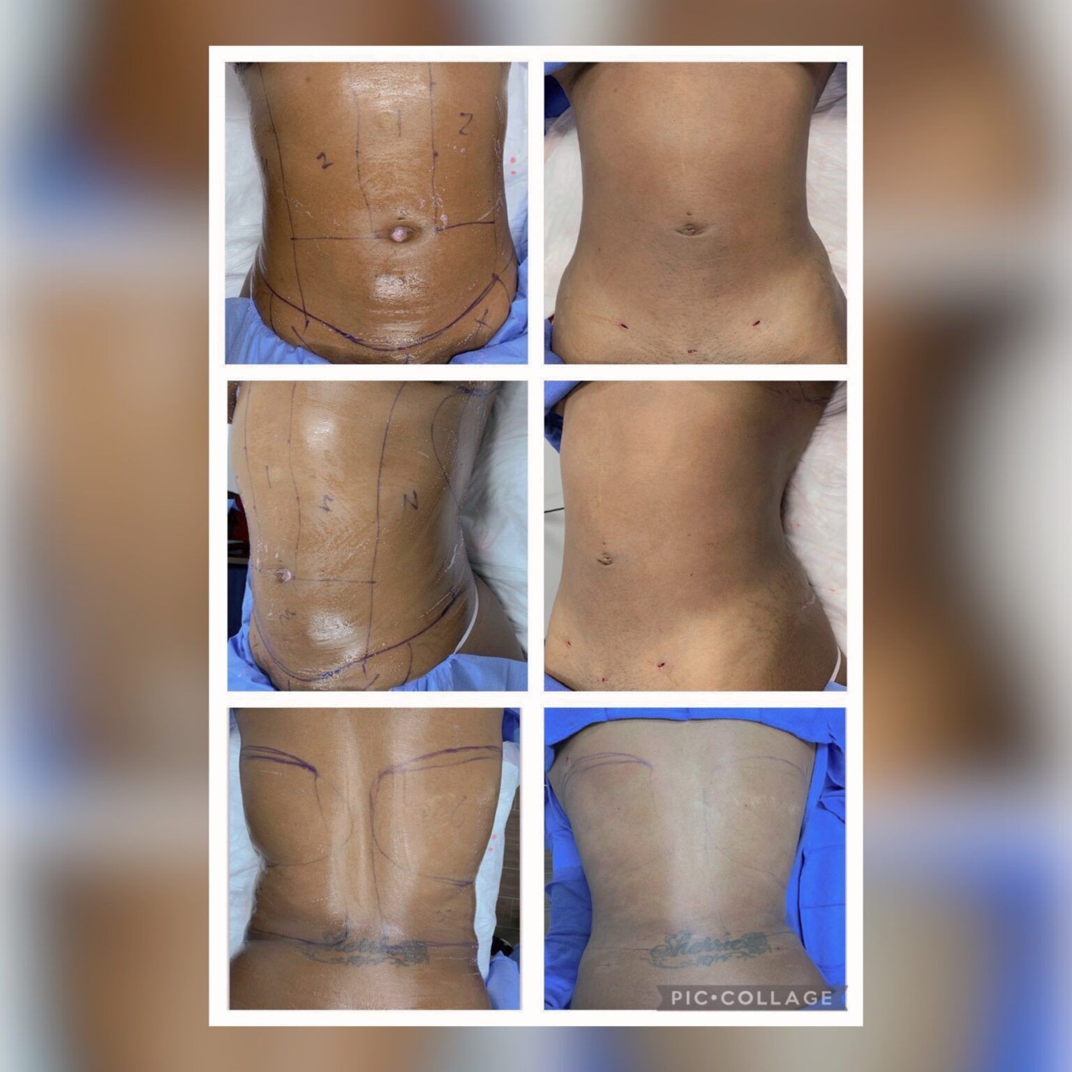 Smartlipo 21