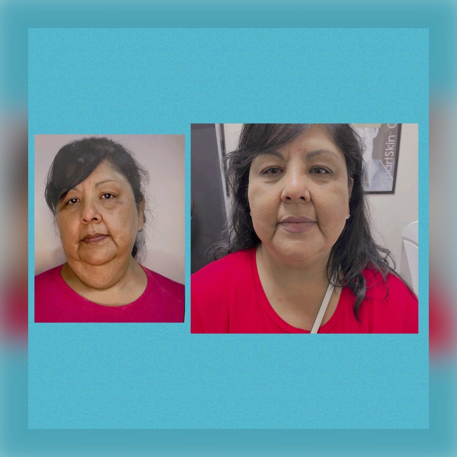 Smartlipo 22