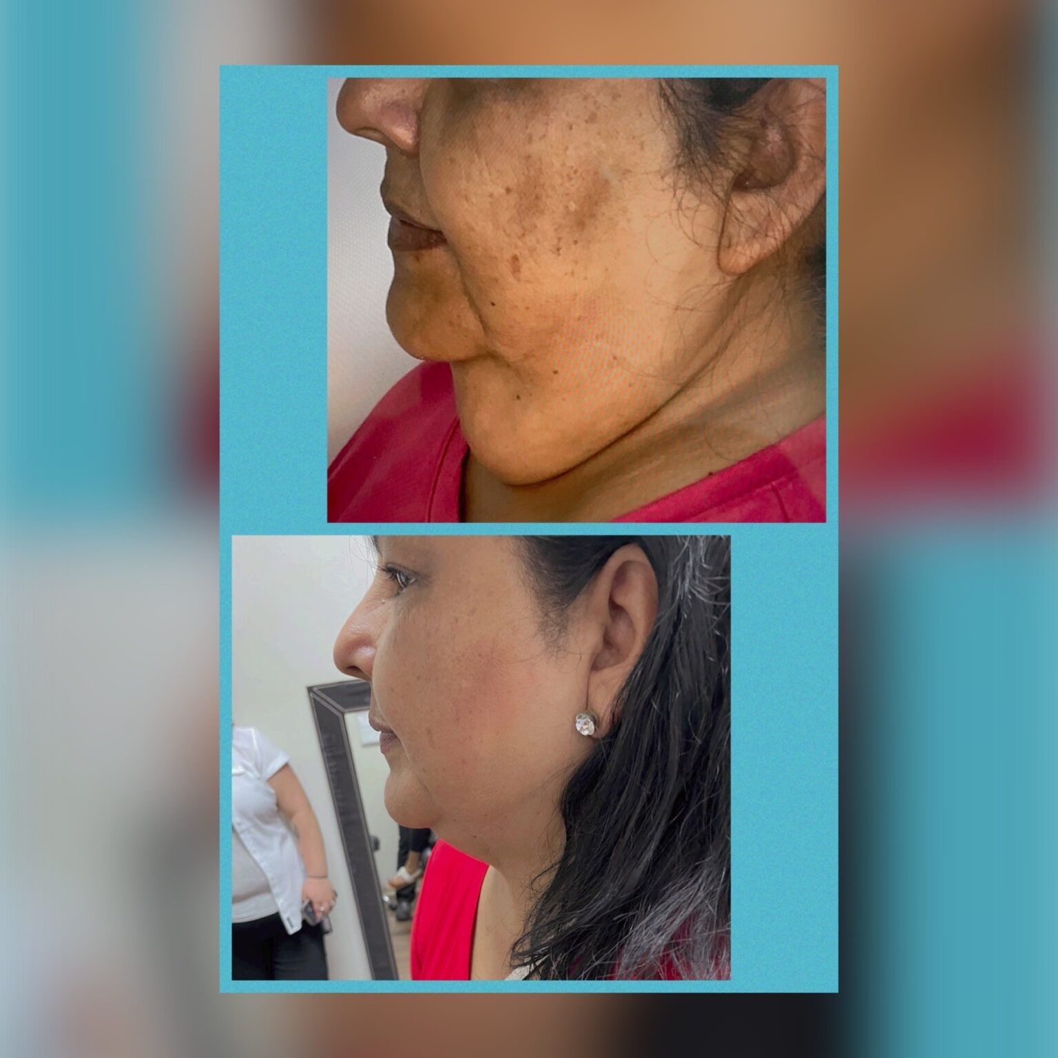 Smartlipo 23