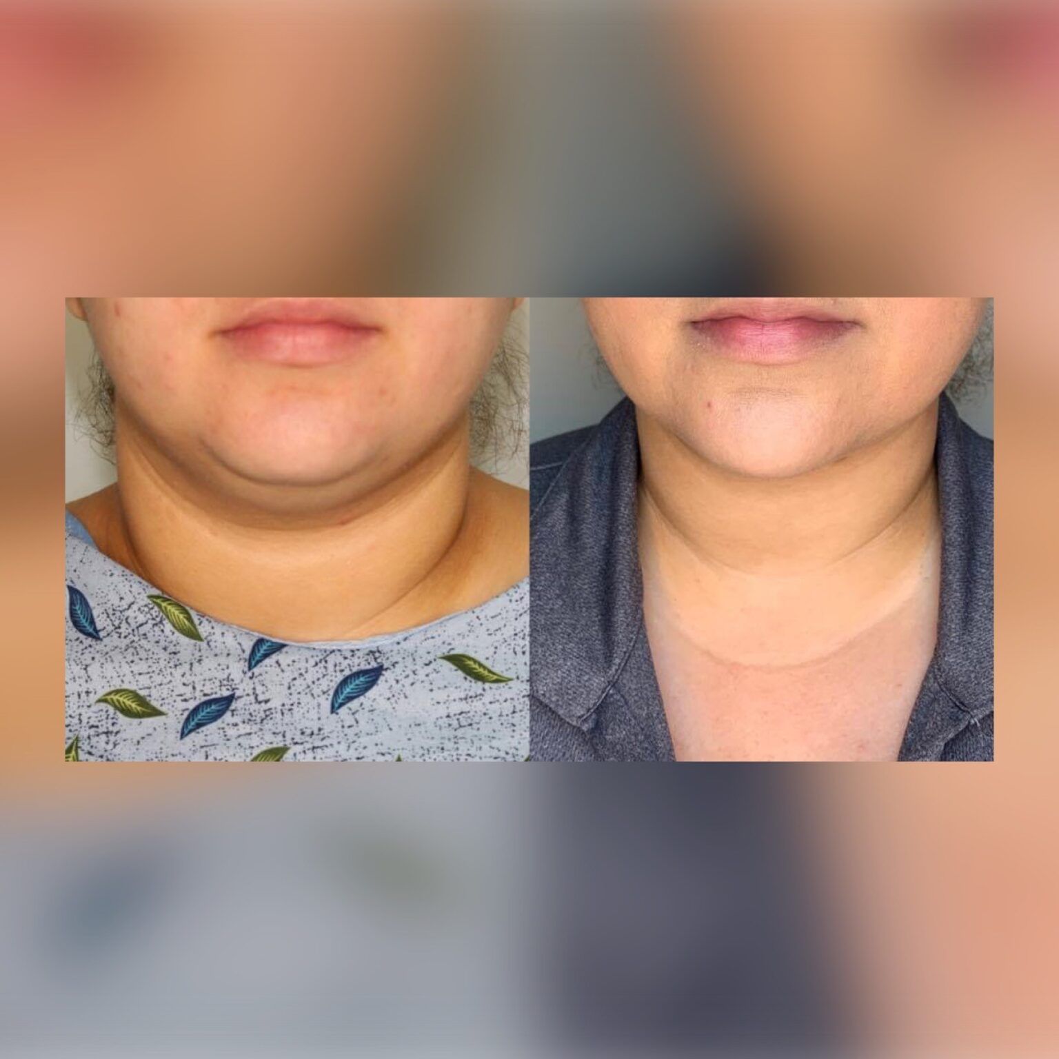 Smartlipo 25