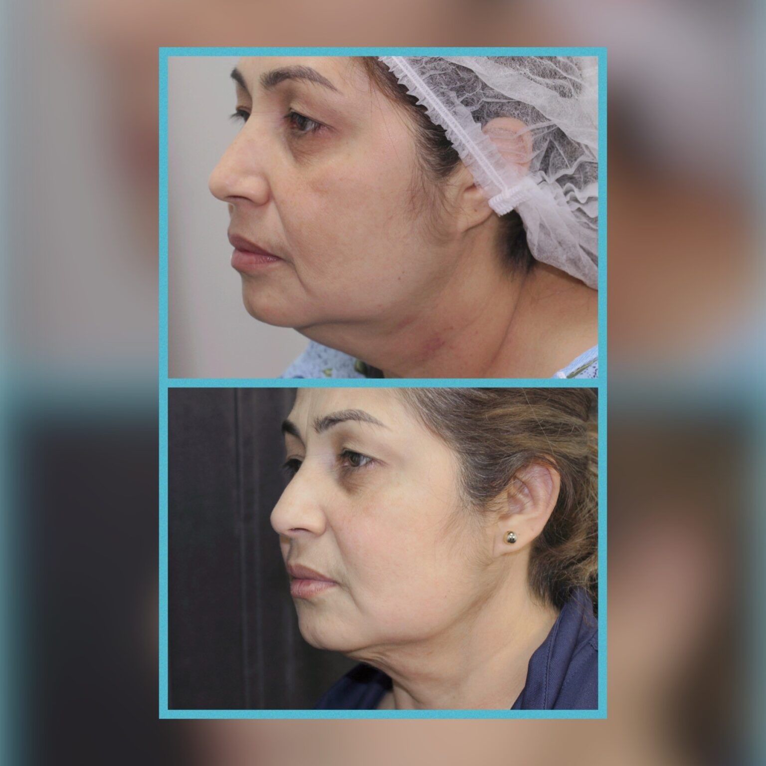 Smartlipo 26
