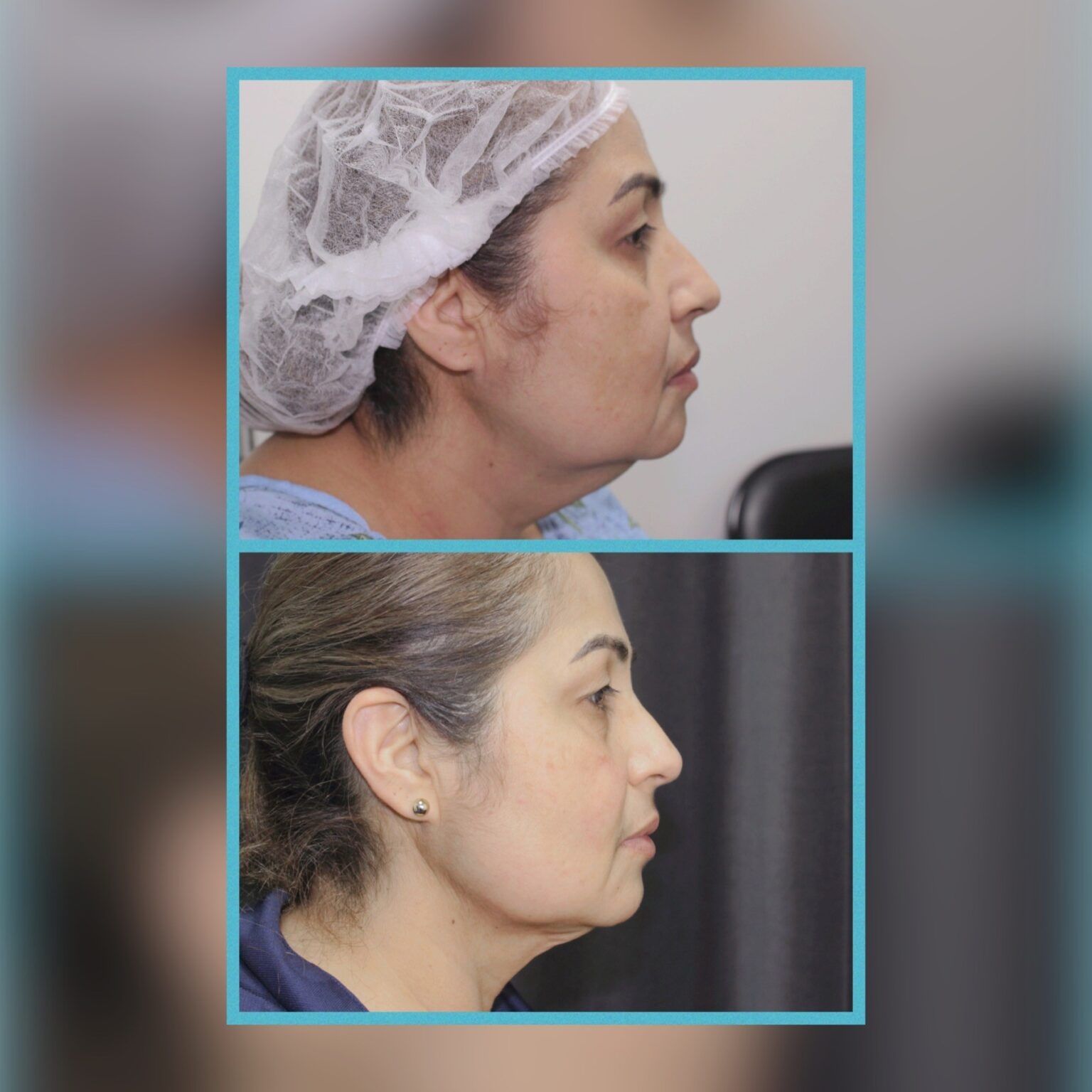 Smartlipo 27
