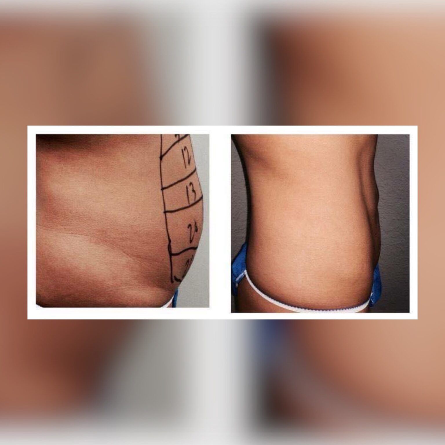 Smartlipo 3