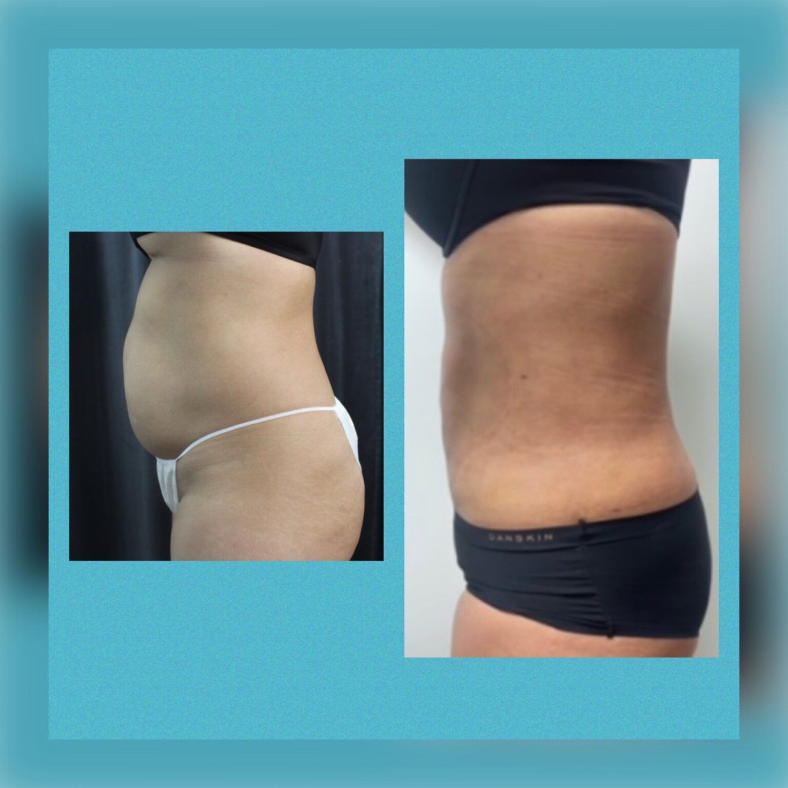 Smartlipo 4