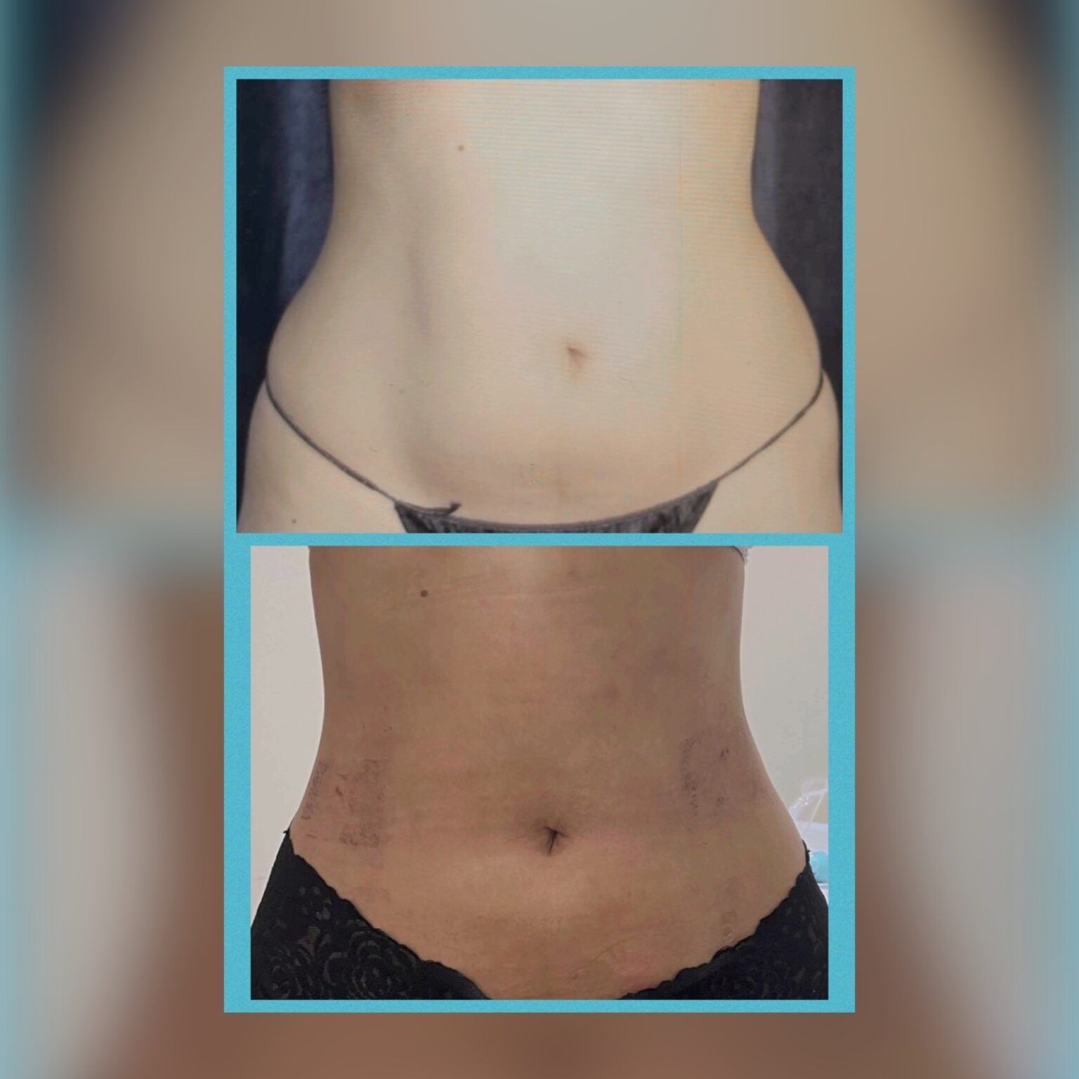 Smartlipo 6