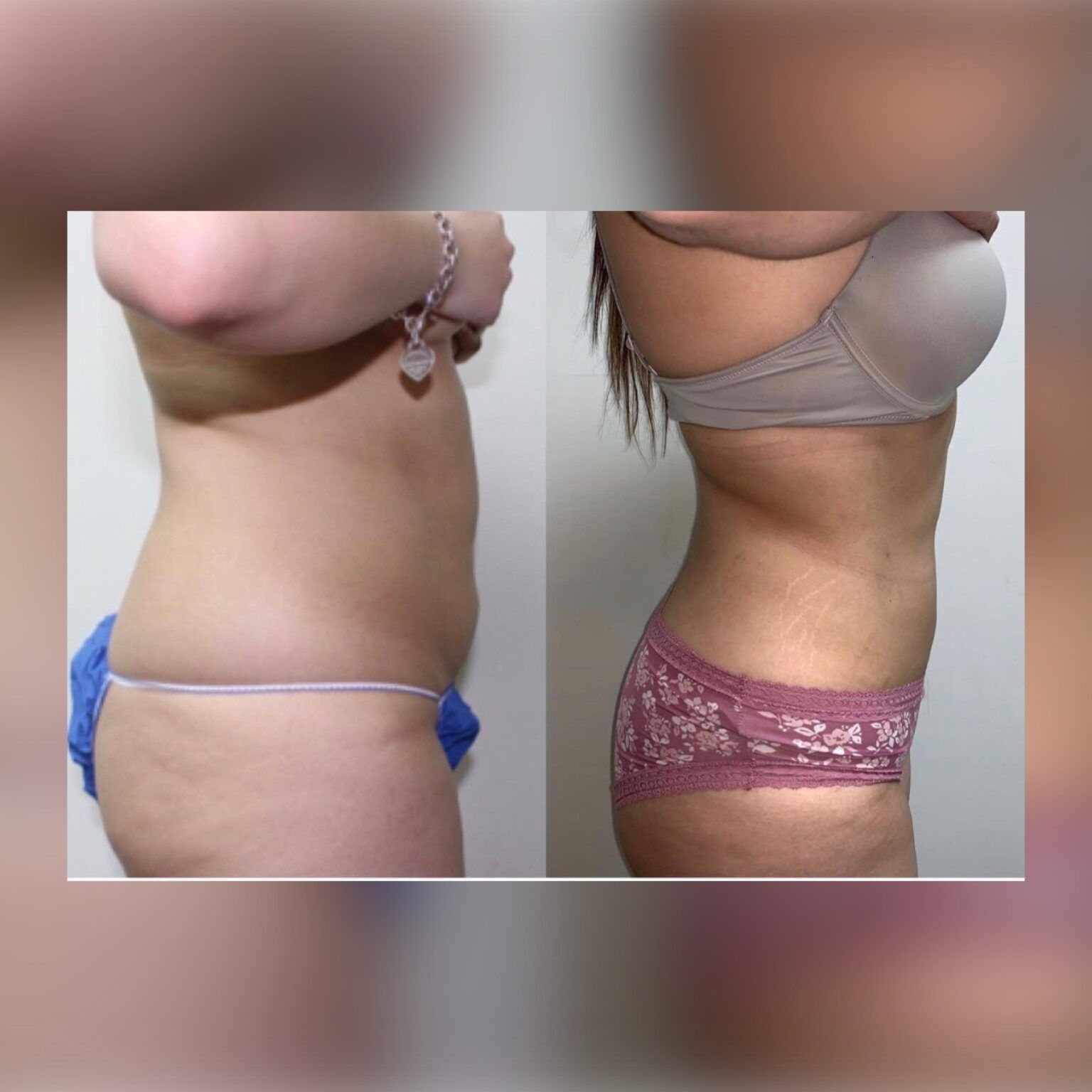 Smartlipo 7